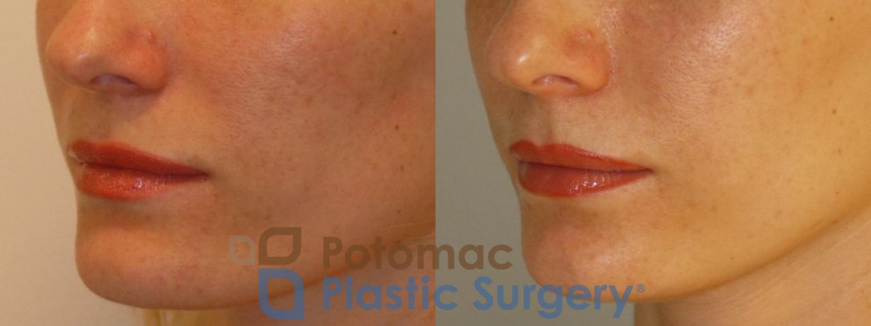 Before & After Liquid Facelift Case 73 Left Oblique View in Washington DC & Arlington , DC