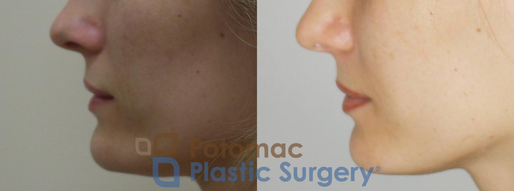 Before & After Liquid Facelift Case 73 Left Side View in Washington DC & Arlington , DC
