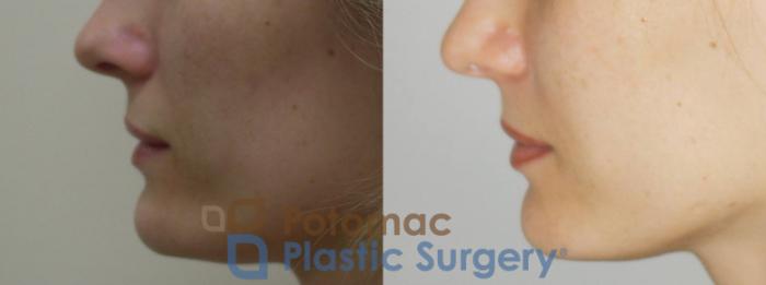 Before & After Liquid Facelift Case 73 Left Side View in Washington, DC