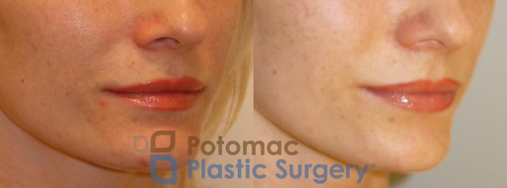 Before & After Liquid Facelift Case 73 Right Oblique View in Washington DC & Arlington , DC