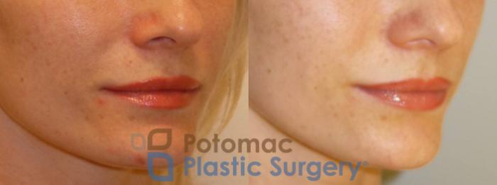 Before & After Liquid Facelift Case 73 Right Oblique View in Washington, DC