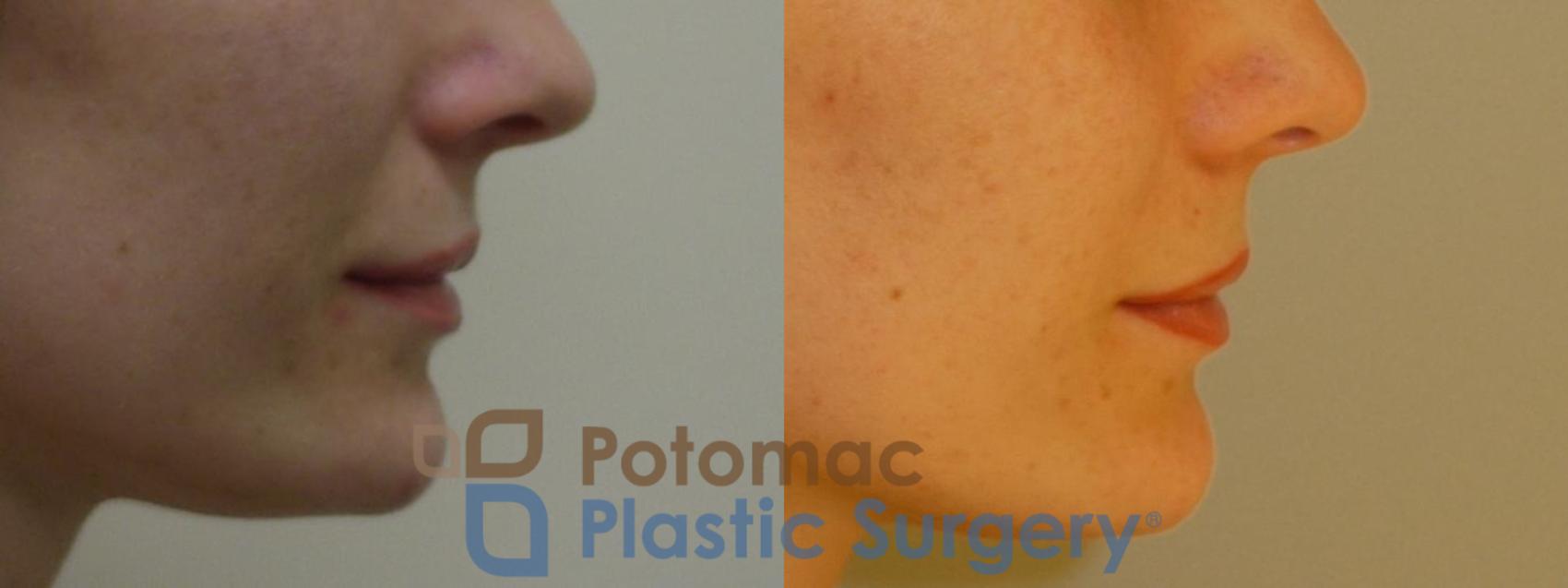 Before & After Liquid Facelift Case 73 Right Side View in Washington DC & Arlington , DC