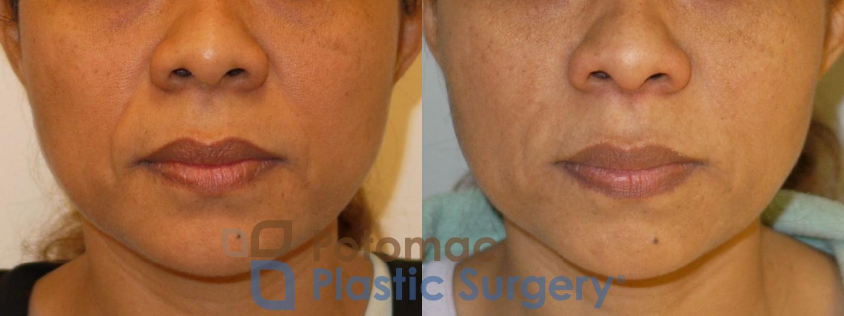 Before & After Liquid Facelift Case 92 Front View in Washington DC & Arlington , DC