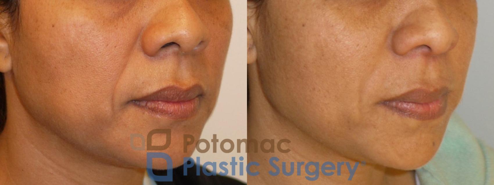 Before & After Dermal Fillers Case 92 Right Oblique View in Washington, DC