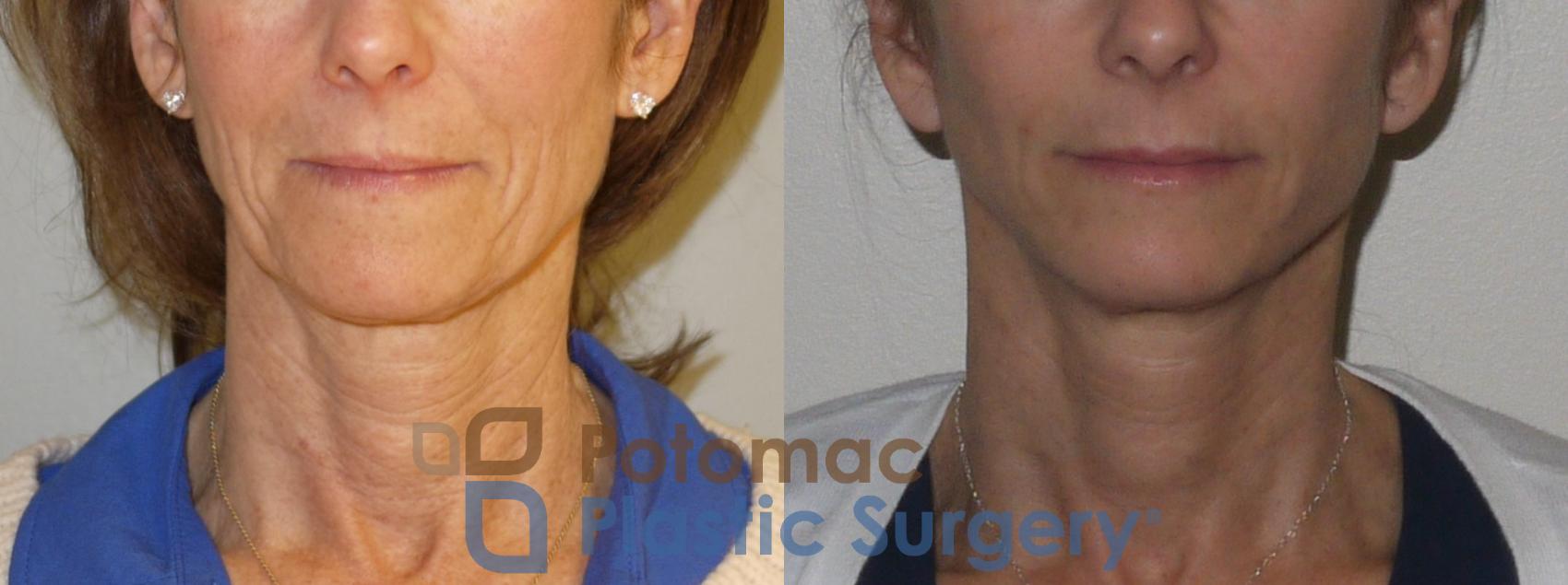 Before & After Liquid Facelift Case 100 Front View in Washington, DC