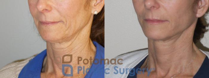 Before & After Liposuction Case 100 Left Oblique View in Washington DC & Arlington , DC