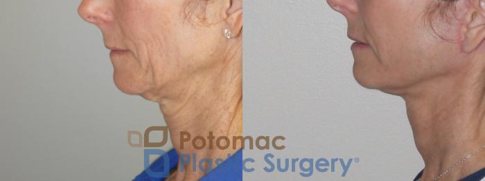 Before & After Liposuction Case 100 Left Side View in Washington DC & Arlington , DC