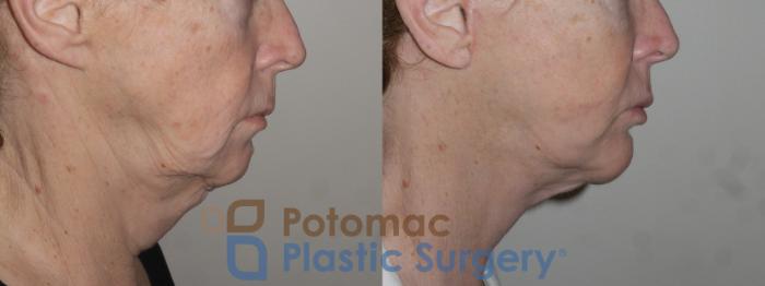 Before & After Neck Lift Case 119 Right Side View in Washington DC & Arlington , DC