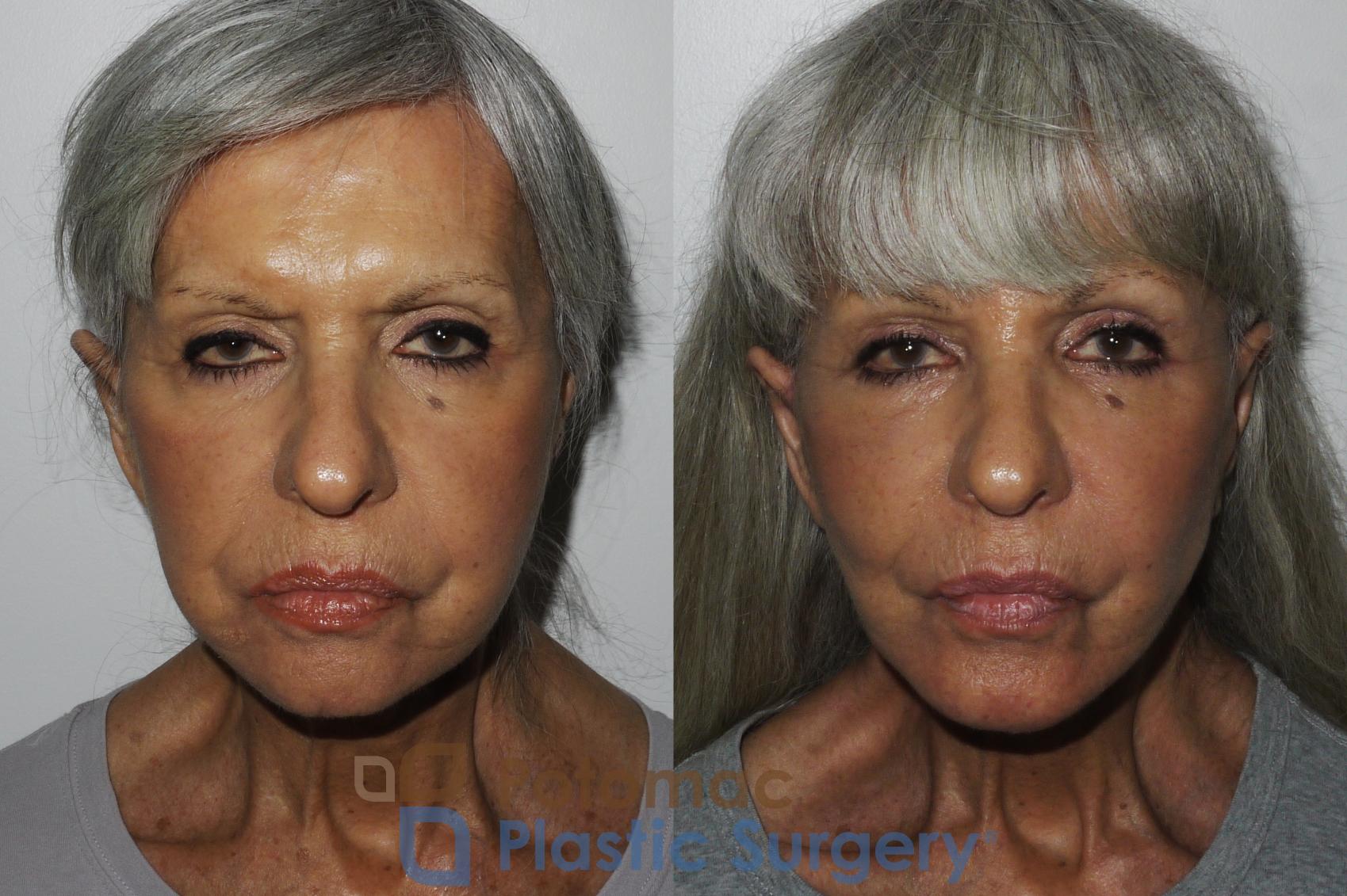 Before & After Brow Lift Case 157 Front View in Washington, DC