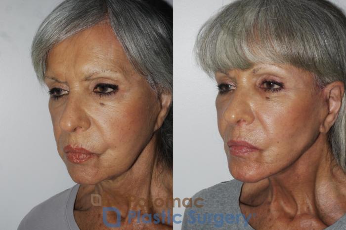 Before & After Brow Lift Case 157 Left Oblique View in Washington, DC