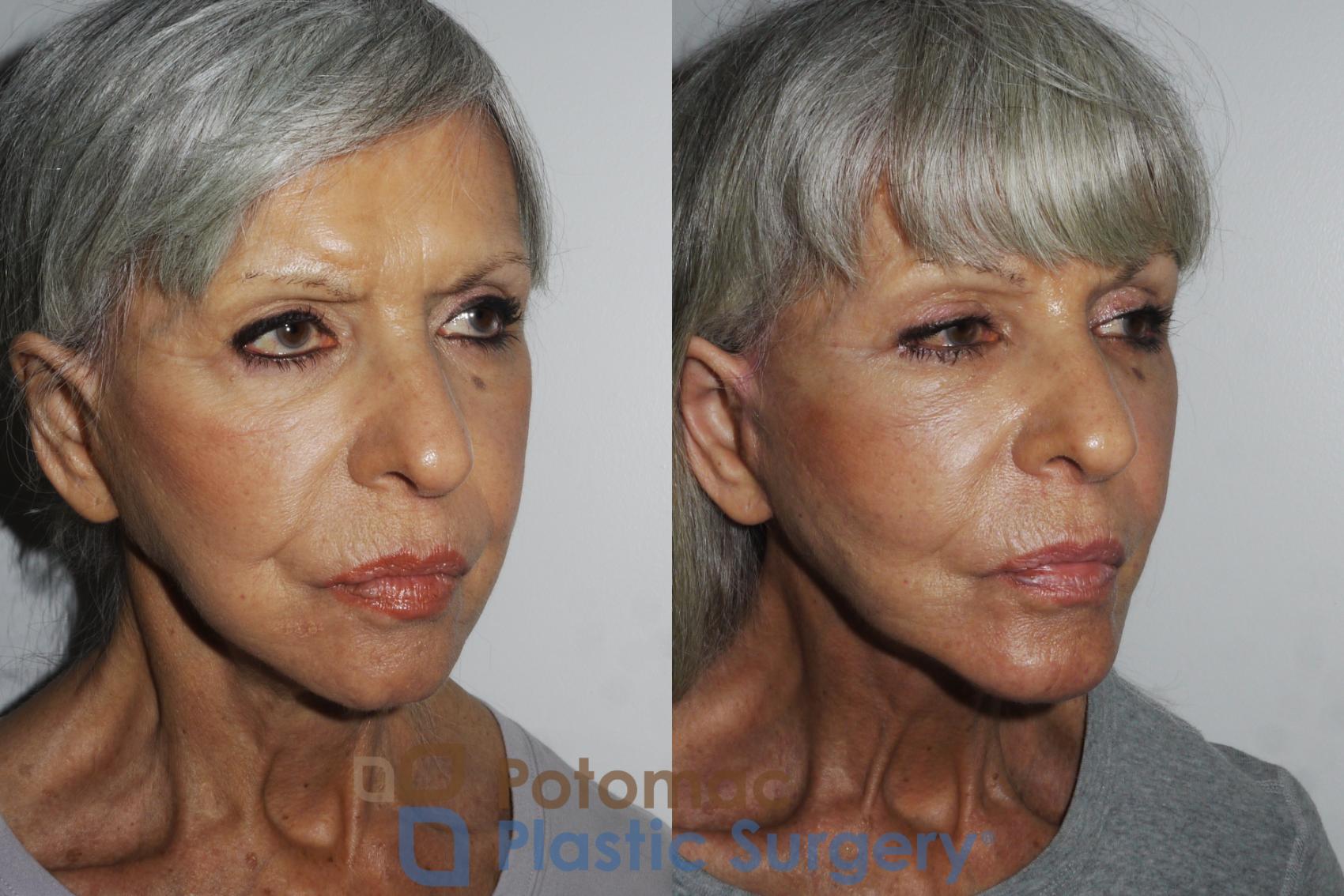 Before & After Facelift Case 157 Right Oblique View in Washington, DC