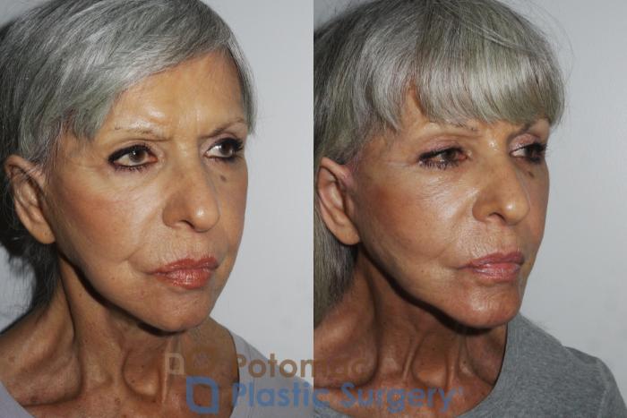 Before & After Brow Lift Case 157 Right Oblique View in Washington, DC
