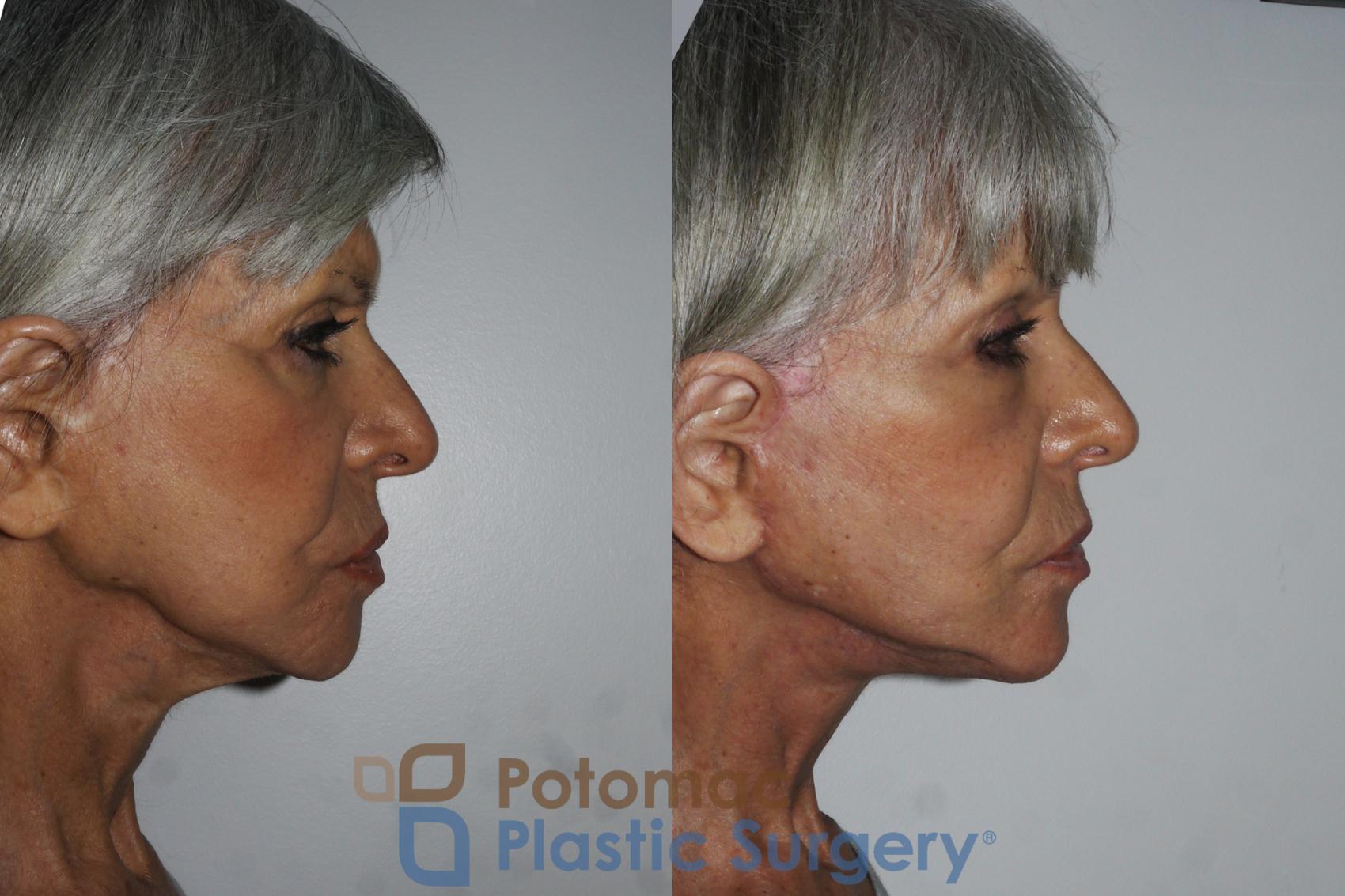 Before & After Facelift Case 157 Right Side View in Washington, DC