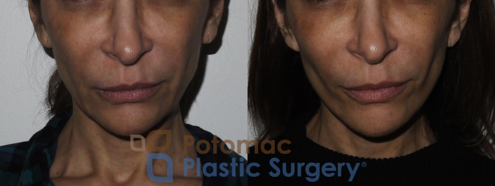 Before & After Neck Lift Case 165 Front View in Washington, DC