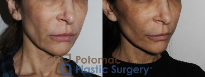 Before & After Facelift Case 165 Right Oblique View in Washington, DC