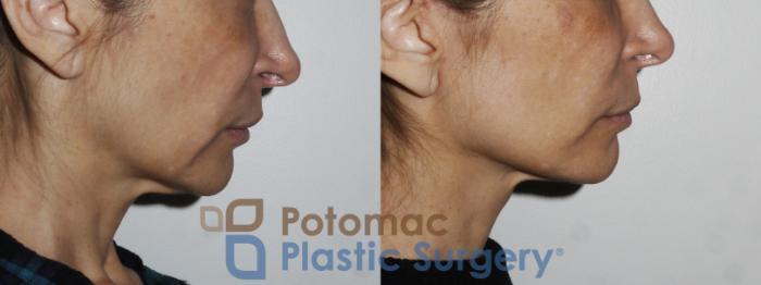 Before & After Facelift Case 165 Right Side View in Washington, DC