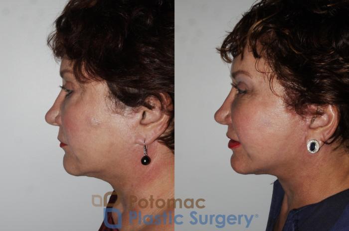 Before & After Liposuction Case 169 Left Side View in Washington DC & Arlington , DC