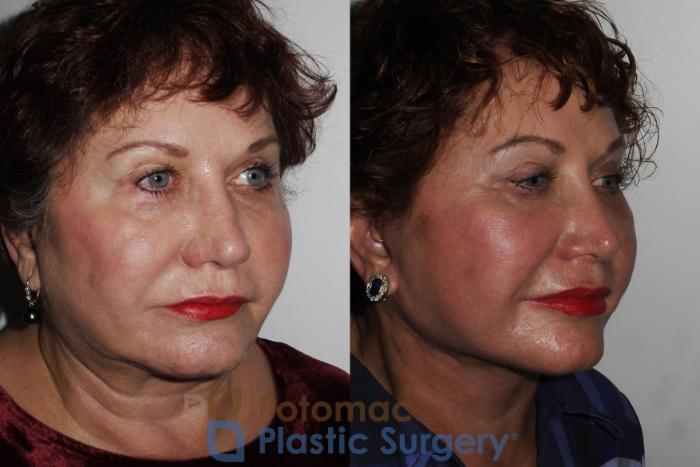 Before & After Liposuction Case 169 Right Oblique View in Washington DC & Arlington , DC