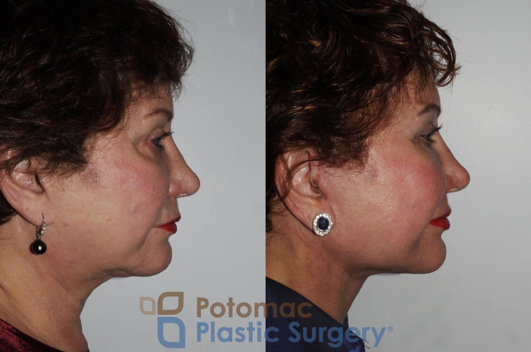 Before & After Facelift Case 169 Right Side View in Washington, DC
