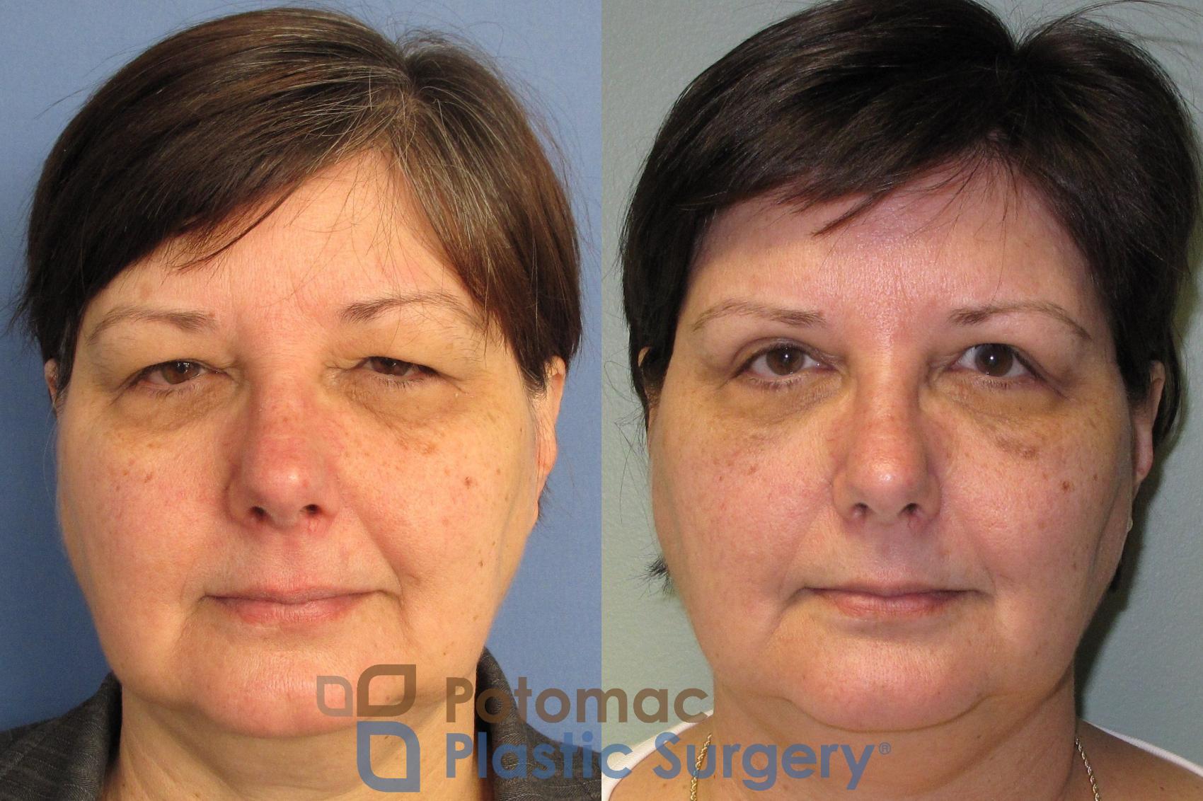 Before & After Blepharoplasty Case 2 Front View in Washington, DC