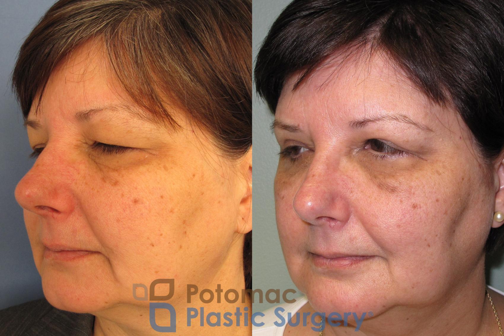 Before & After Brow Lift Case 2 Left Oblique View in Washington, DC