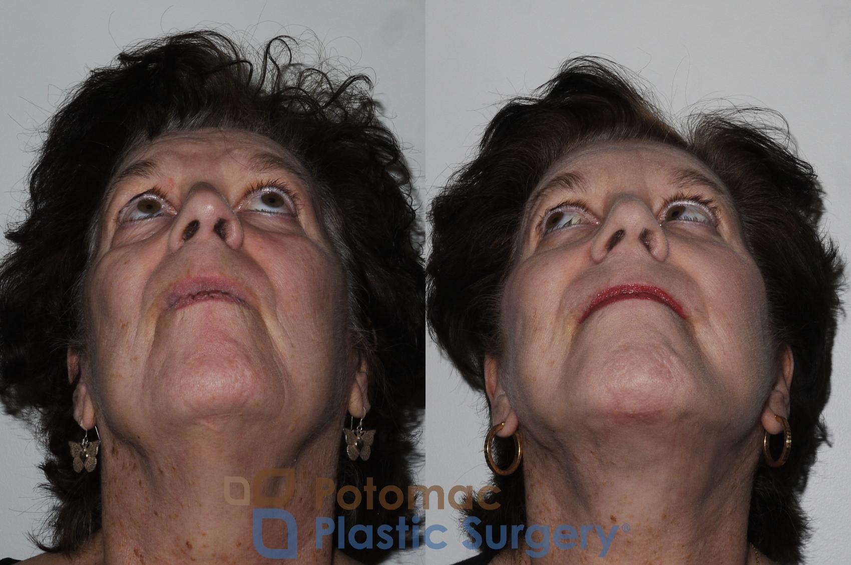 Before & After Facelift Case 206 Below View in Washington, DC