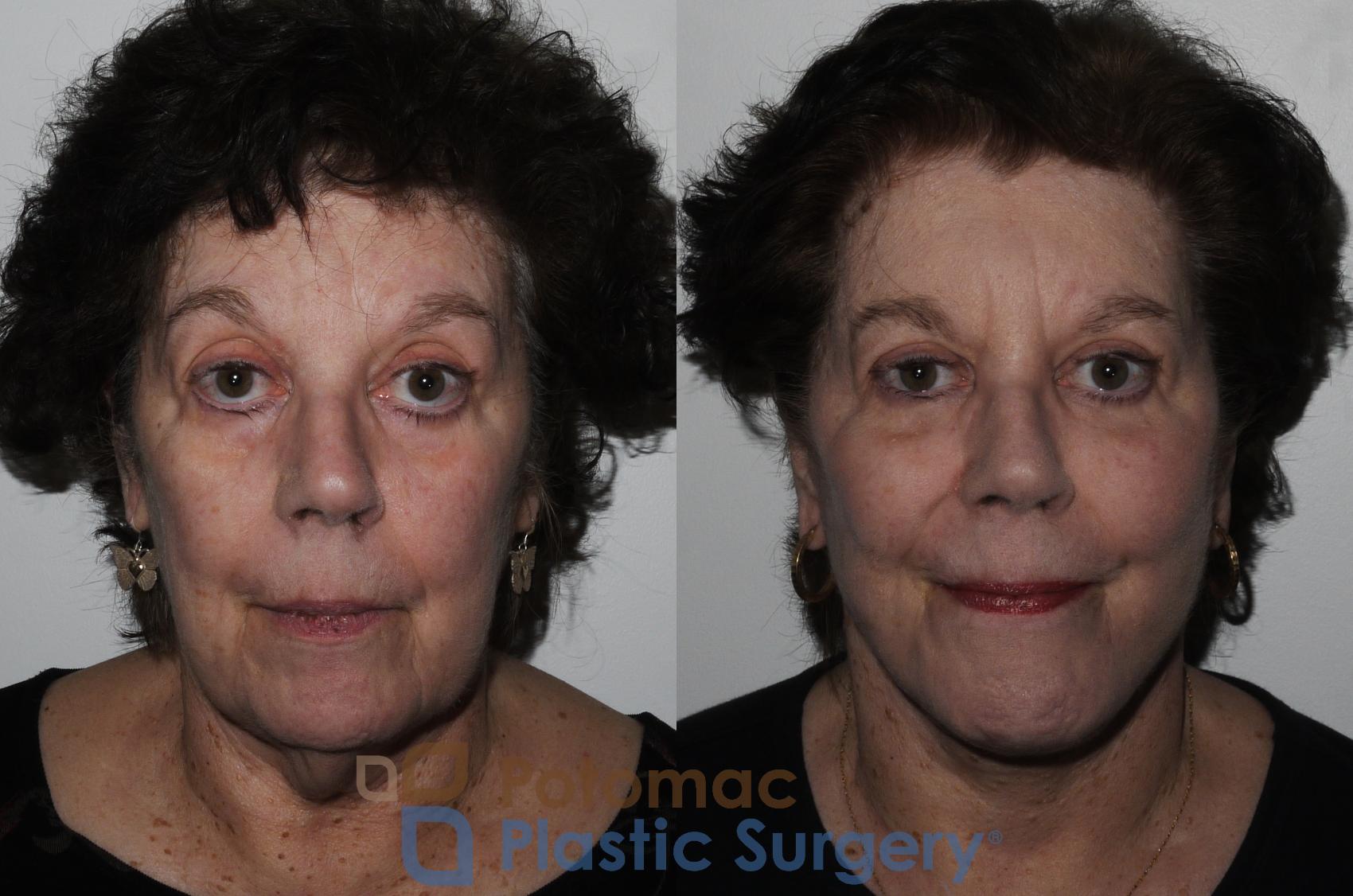 Before & After Facelift Case 206 Front View in Washington, DC