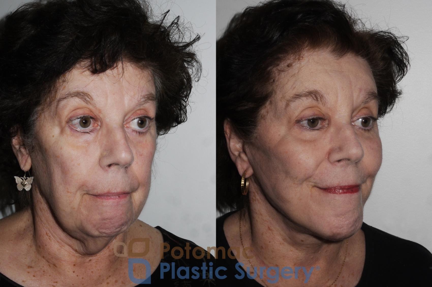 Before & After Neck Lift Case 206 Right Oblique View in Washington, DC