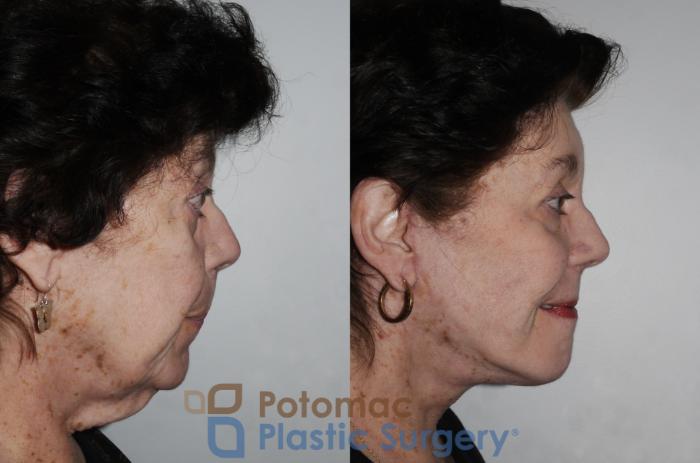 Before & After Facelift Case 206 Right Side View in Washington, DC