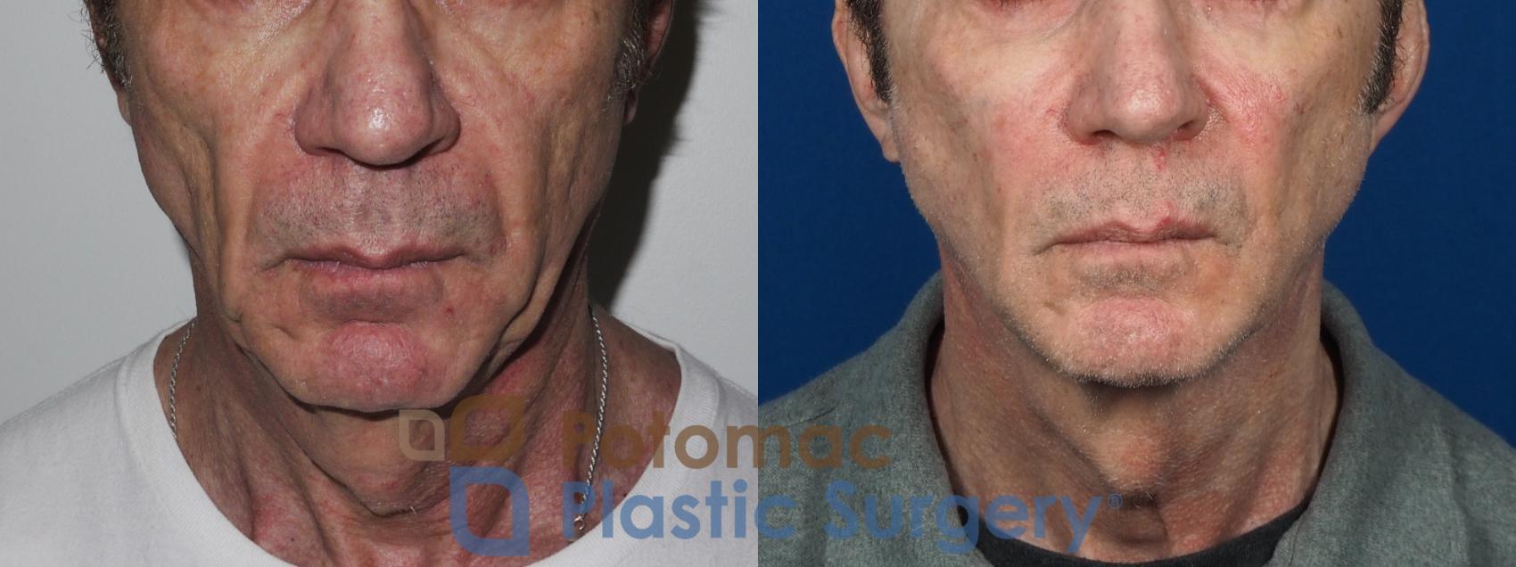Before & After Neck Lift Case 225 Front View in Washington, DC