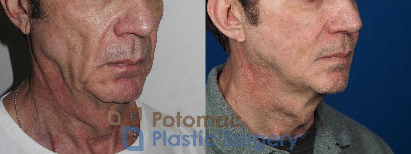 Before & After Facelift Case 225 Right Oblique View in Washington, DC