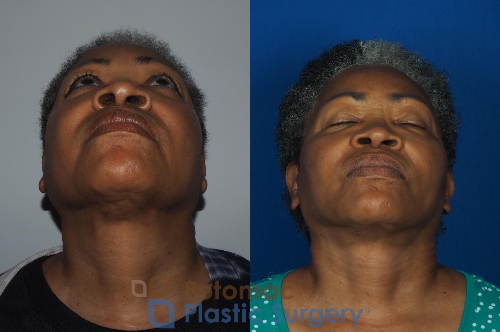 Facelift with facial fat transfer to refresh the appearance of an older ...