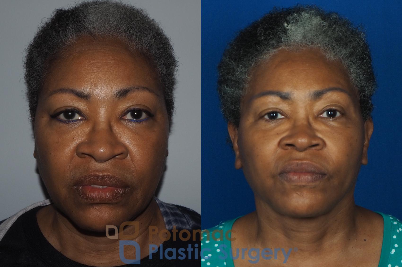 Before & After Neck Lift Case 234 Front View in Washington, DC