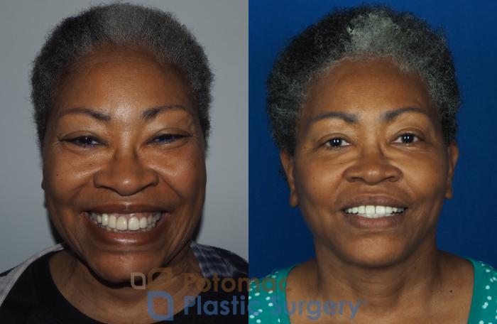 Before & After Facelift Case 234 Front - Smiling View in Washington, DC