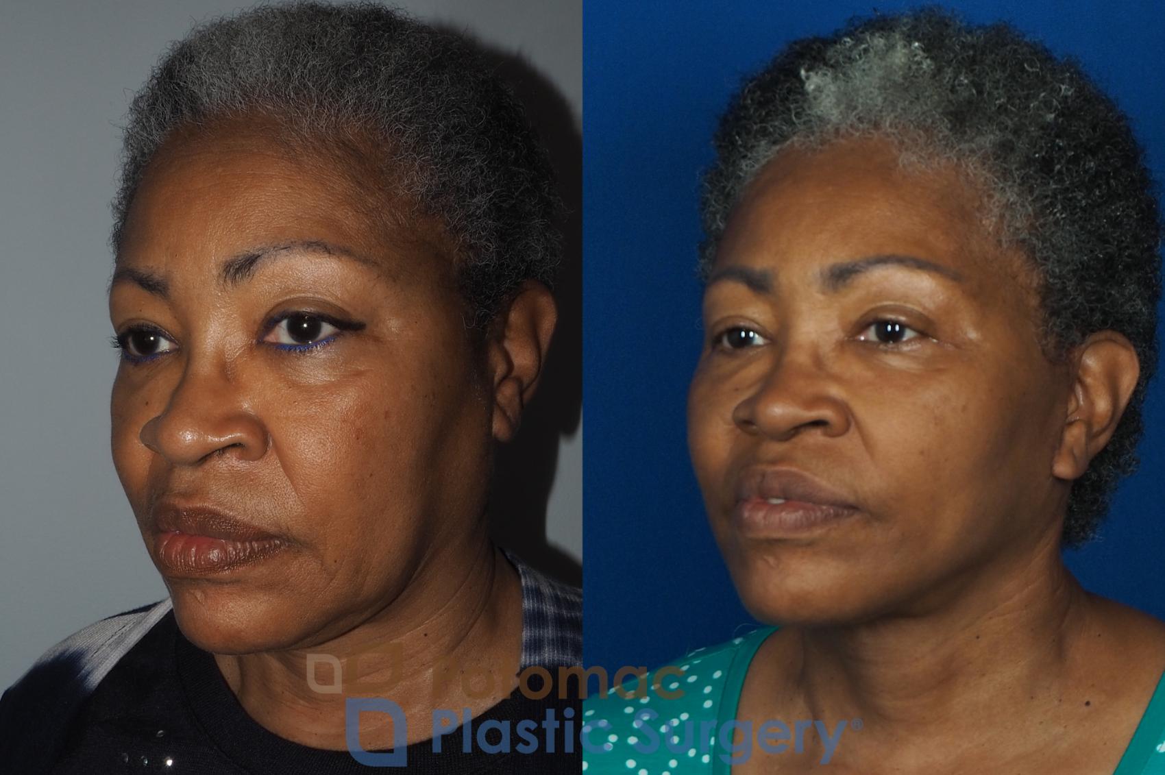 Before & After Facial Sculpting Case 234 Left Oblique View in Washington DC & Arlington , DC