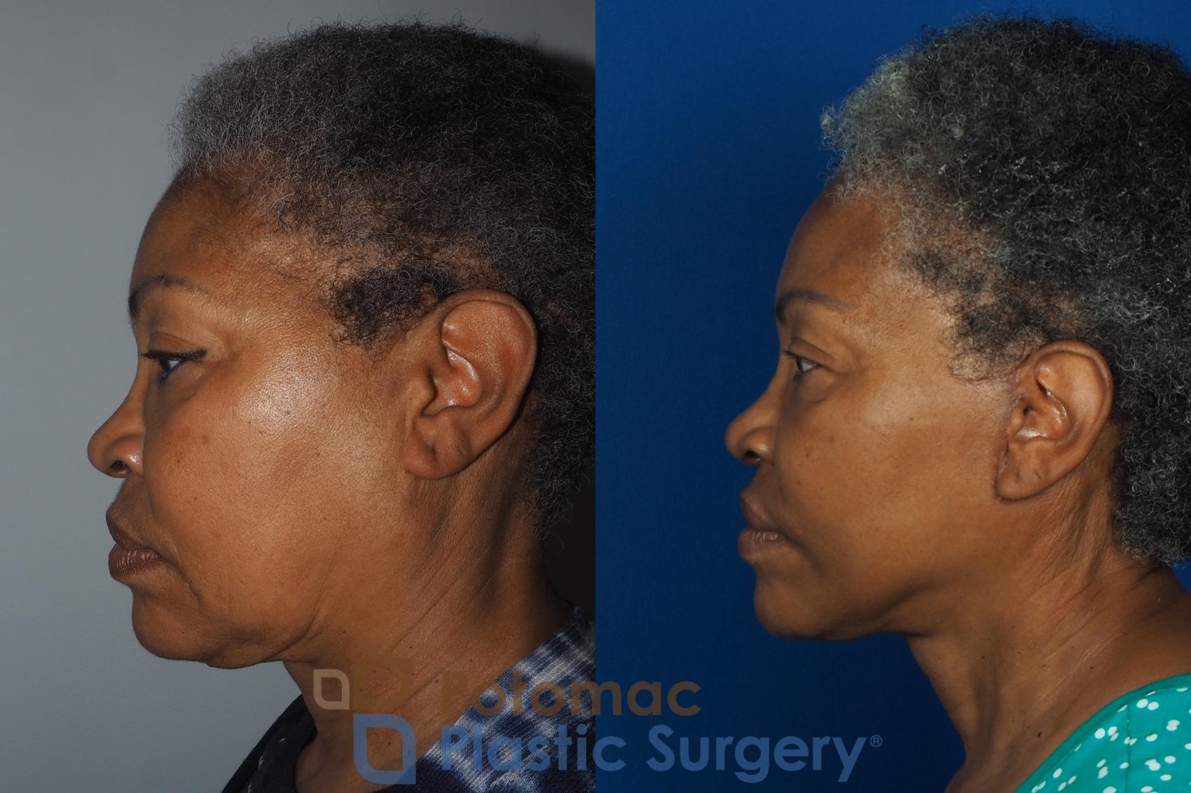 Before & After Facelift Case 234 Left Side View in Washington, DC