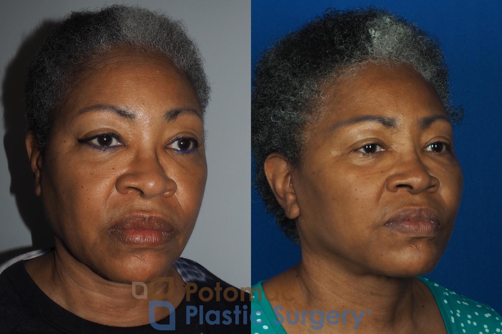 Before & After Facelift Case 234 Right Oblique View in Washington, DC