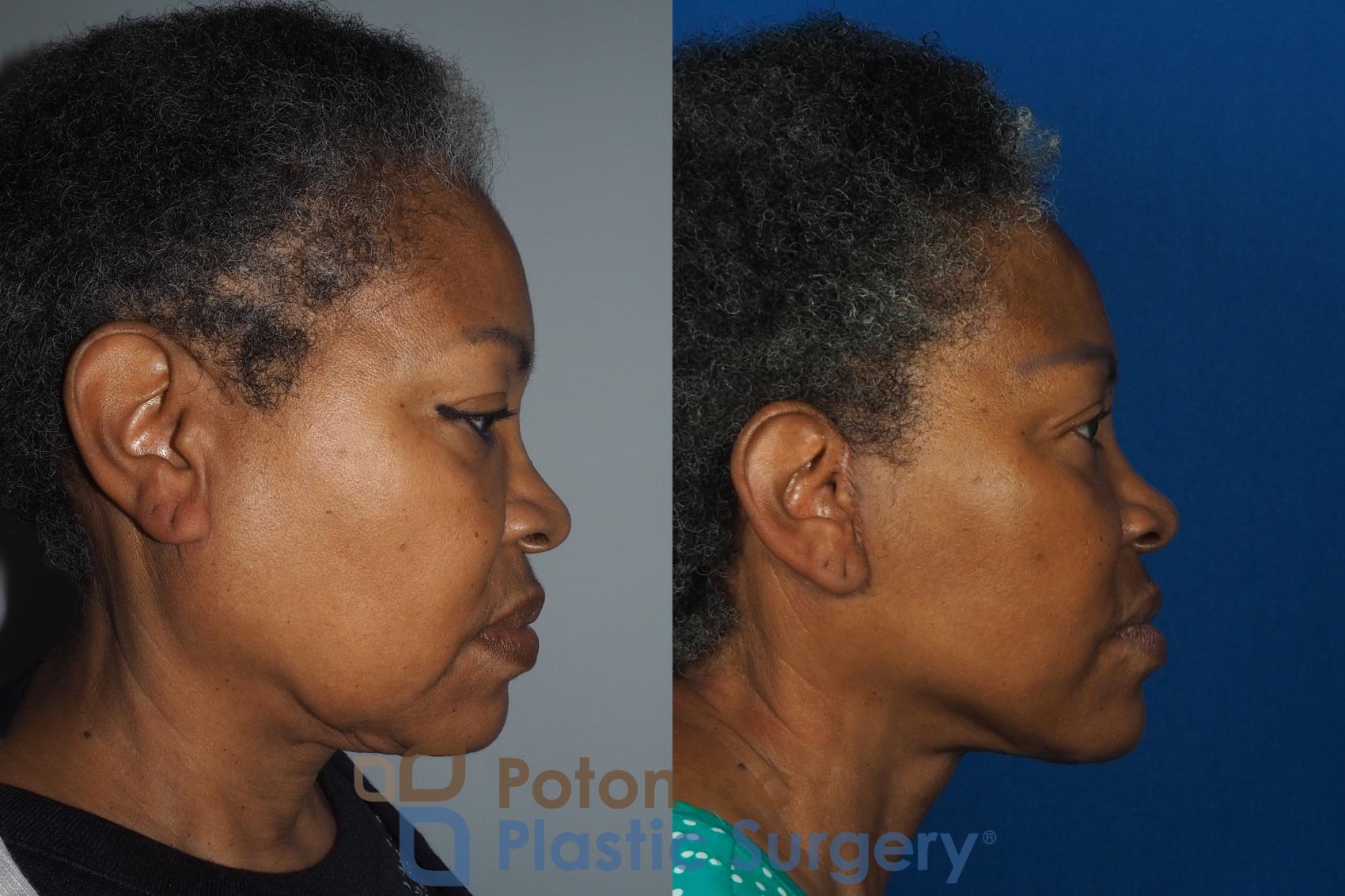 Before & After Facelift Case 234 Right Side View in Washington, DC