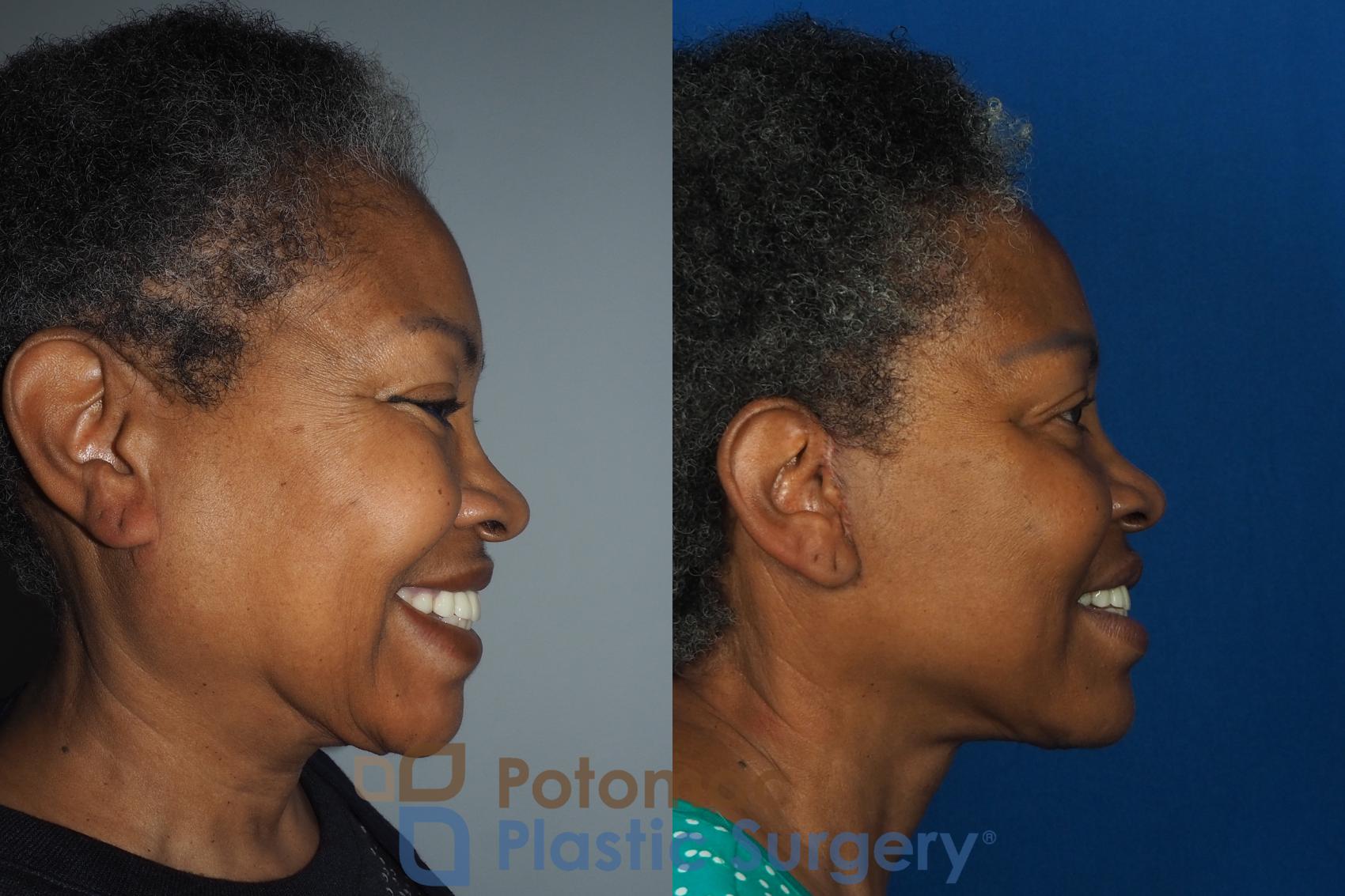 Before & After Facelift Case 234 Right Side - Smiling View in Washington, DC
