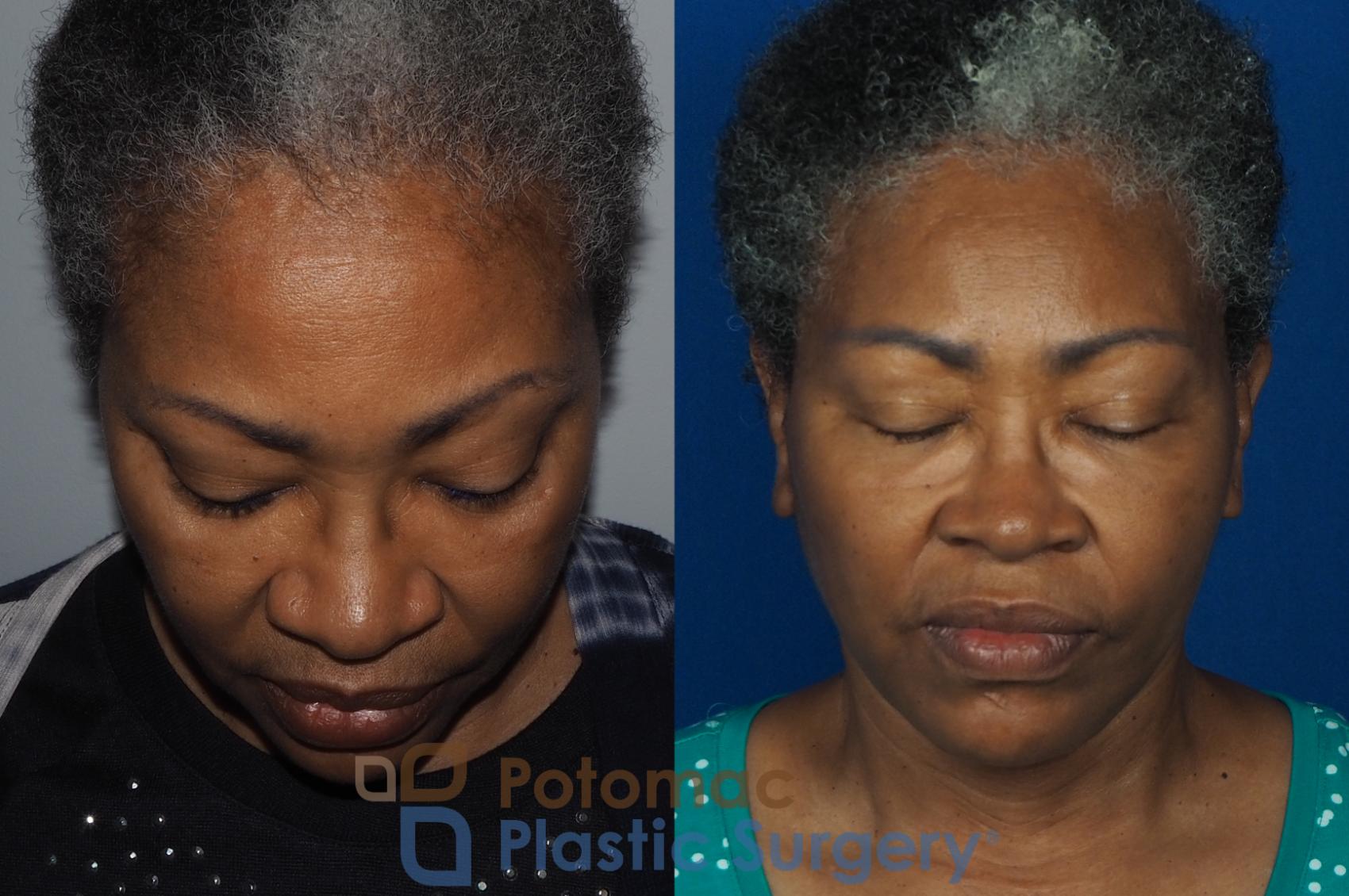 Before & After Facial Sculpting Case 234 Top View in Washington DC & Arlington , DC