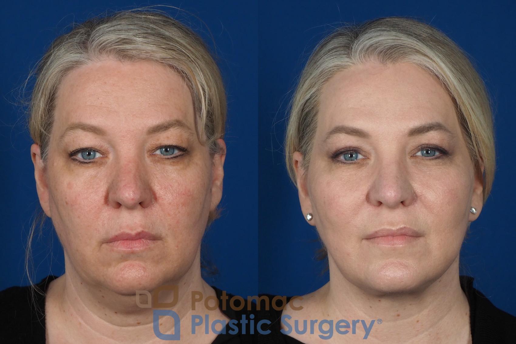 Before & After Liposuction Case 252 Front View in Washington, DC