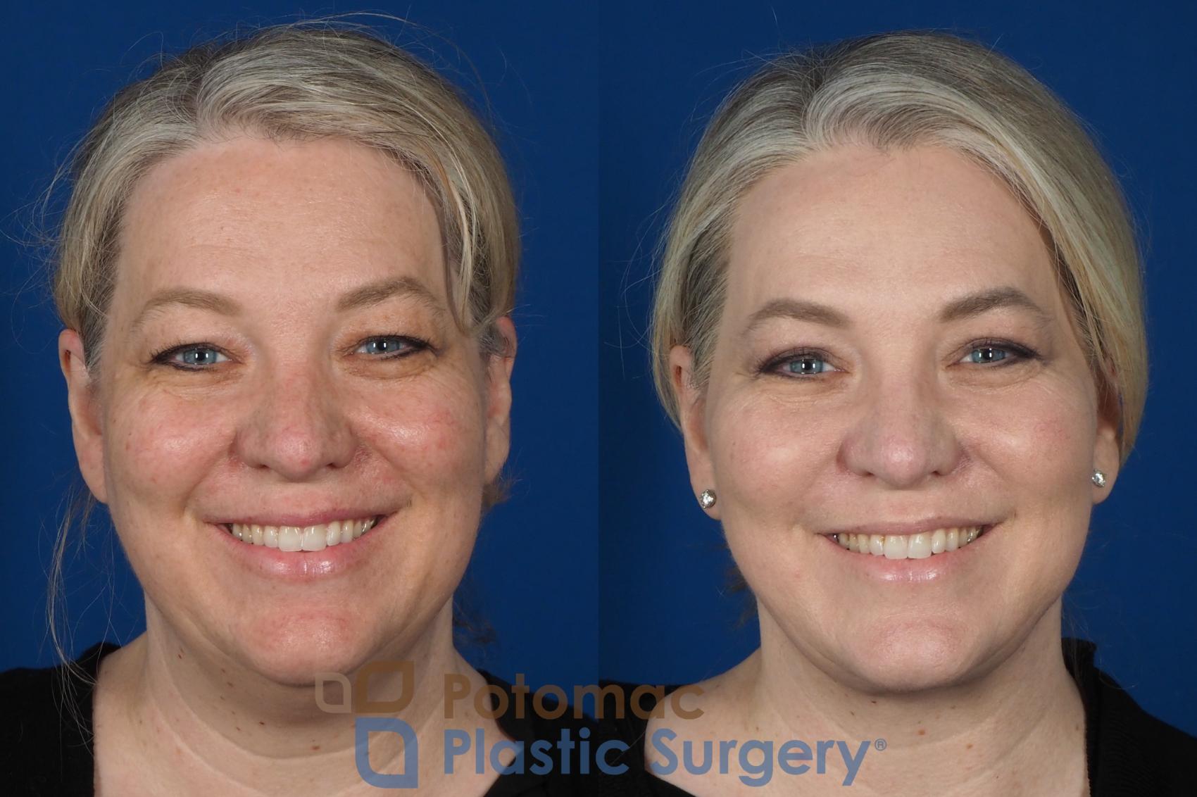 Before & After Blepharoplasty Case 252 Front - Smiling View in Washington, DC