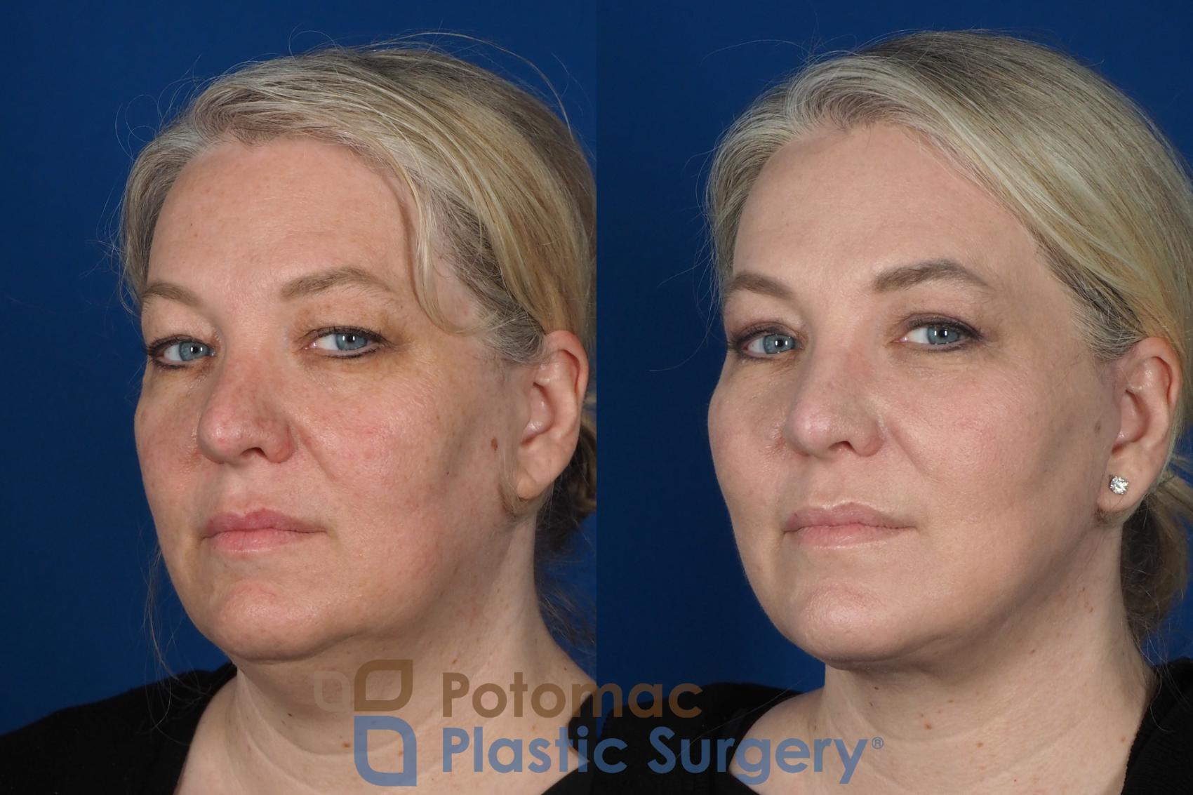 Before & After Blepharoplasty Case 252 Left Oblique View #2 View in Washington, DC