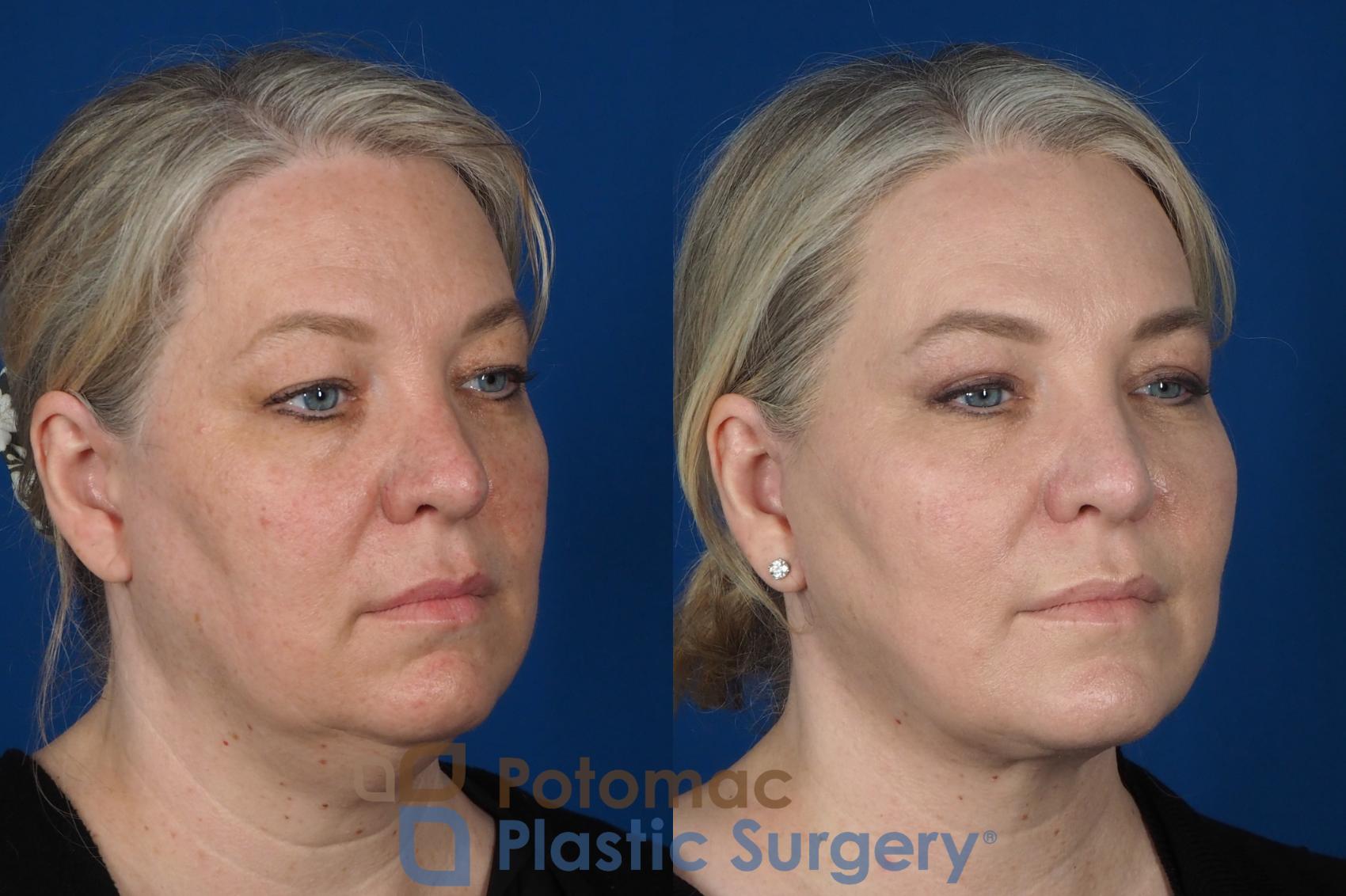 Before & After Blepharoplasty Case 252 Right Oblique View in Washington, DC