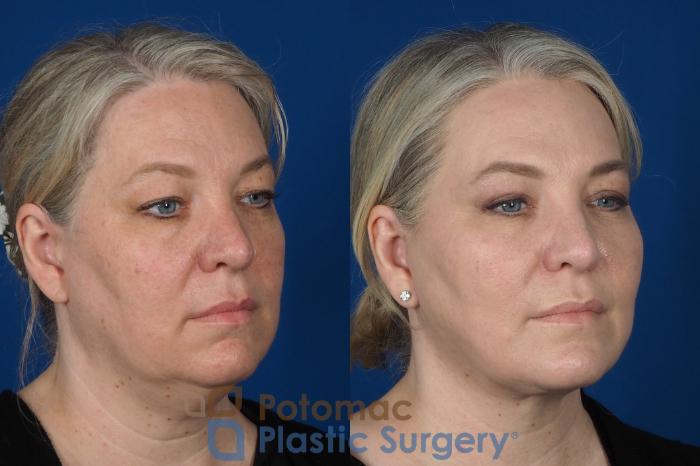 Before & After Facelift Case 252 Right Oblique View in Washington, DC