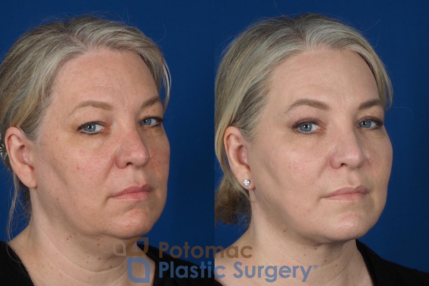 Before & After Facelift Case 252 Right Oblique View #2 View in Washington, DC