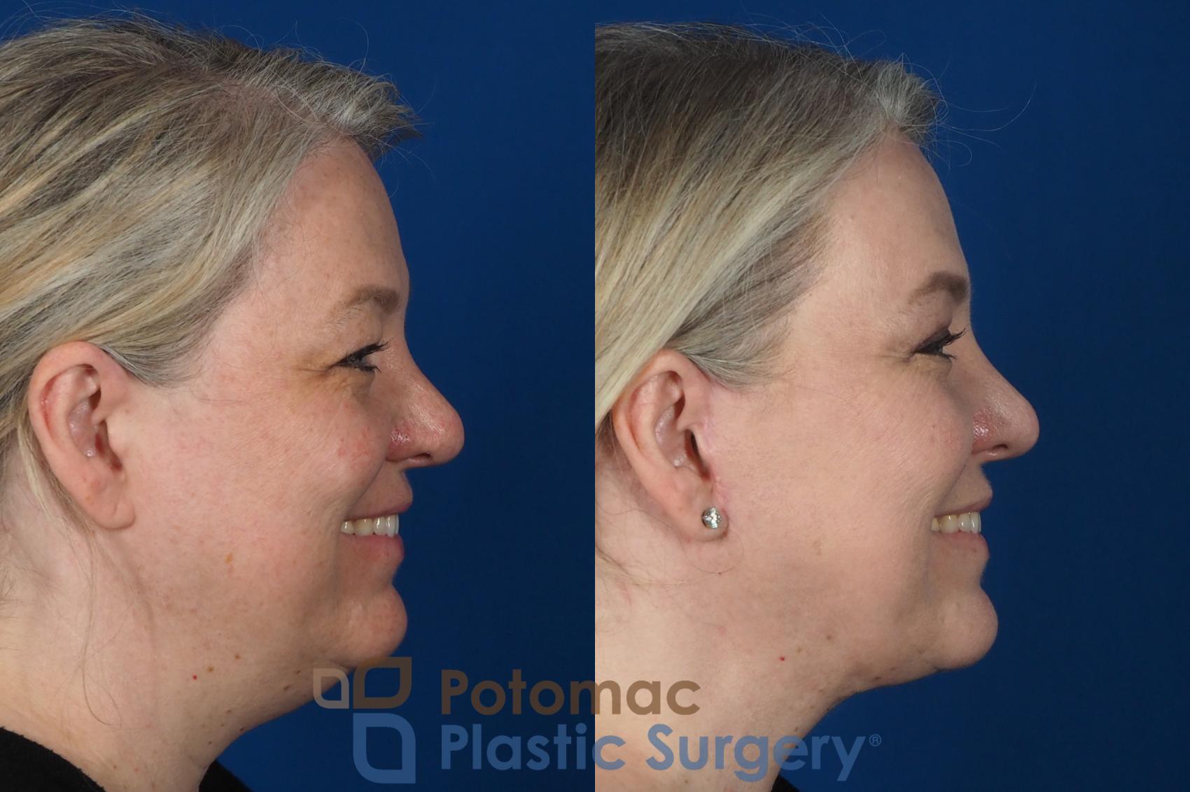 Before & After Blepharoplasty Case 252 Right Side - Smiling View in Washington, DC