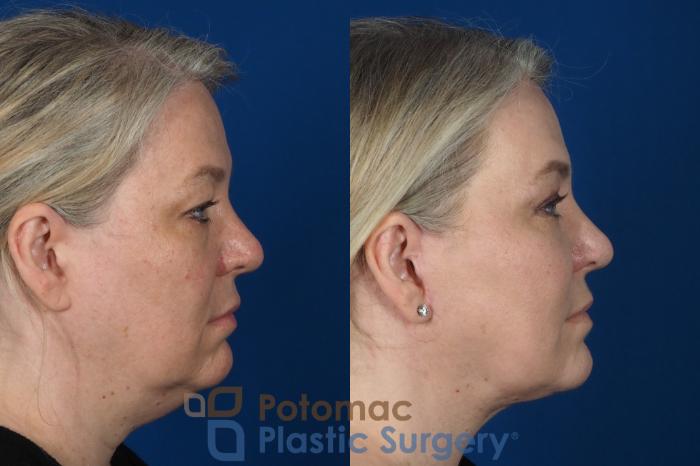 Before & After Facelift Case 252 Right Side View in Washington, DC