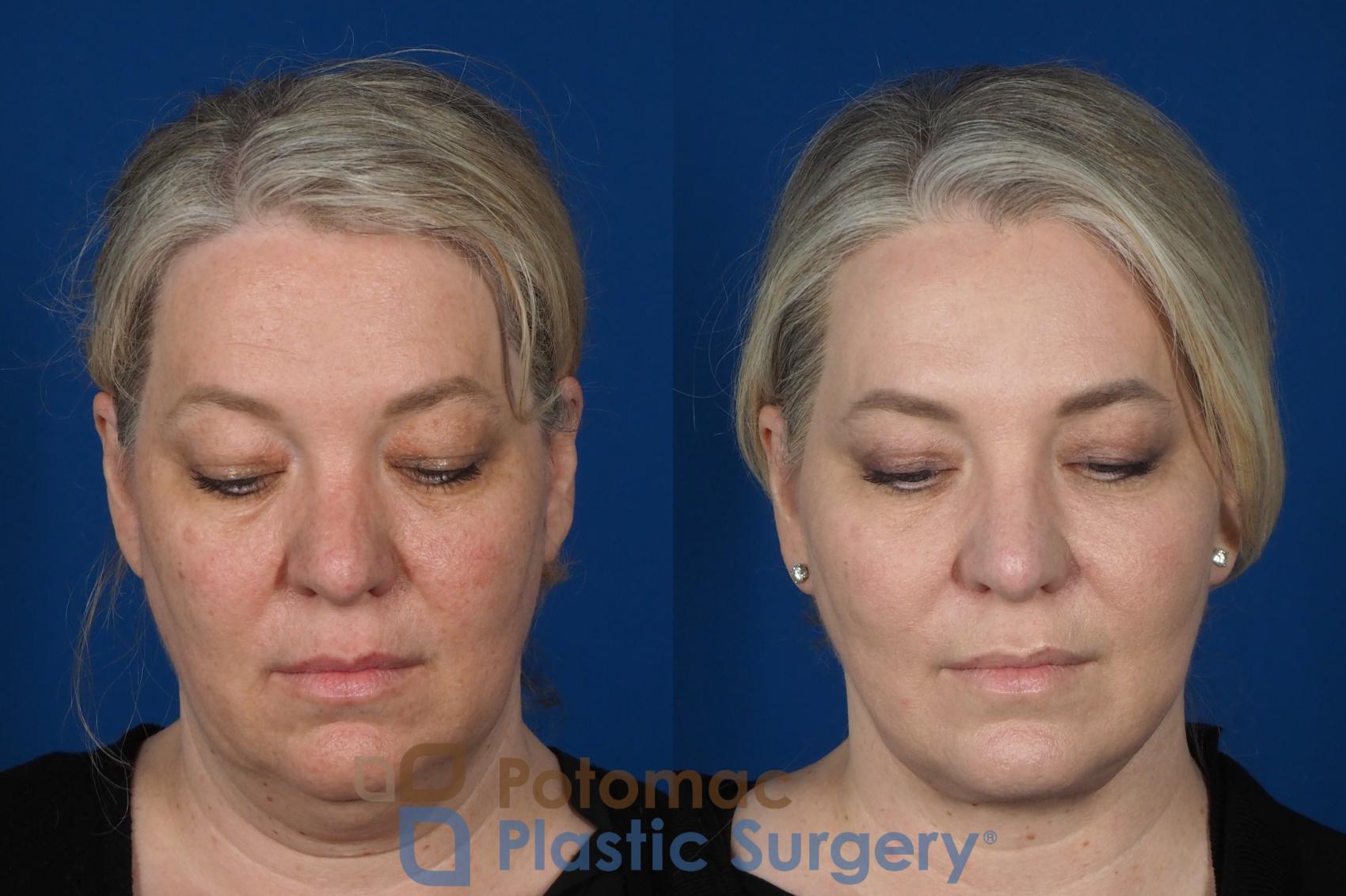 Before & After Blepharoplasty Case 252 Top View in Washington, DC