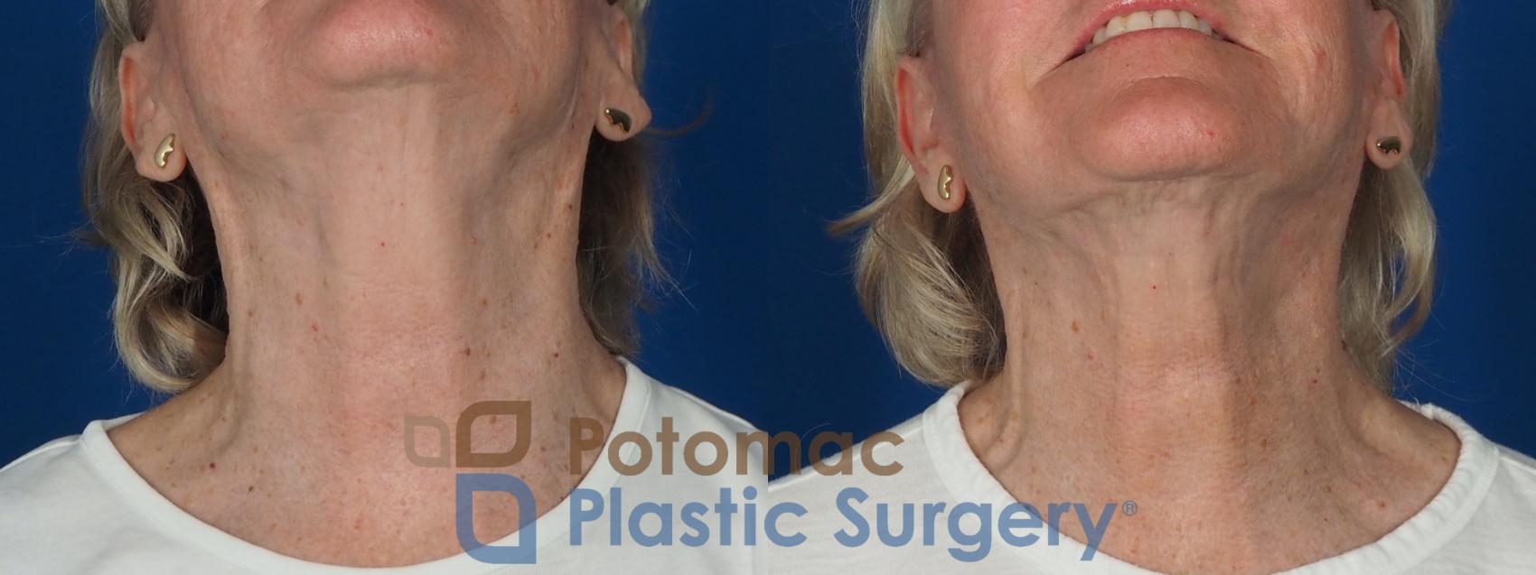 Before & After Facelift Case 279 Bottom View in Washington, DC